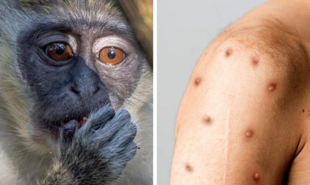 Viruela del mono: ¿Qué es y cómo se contagia?